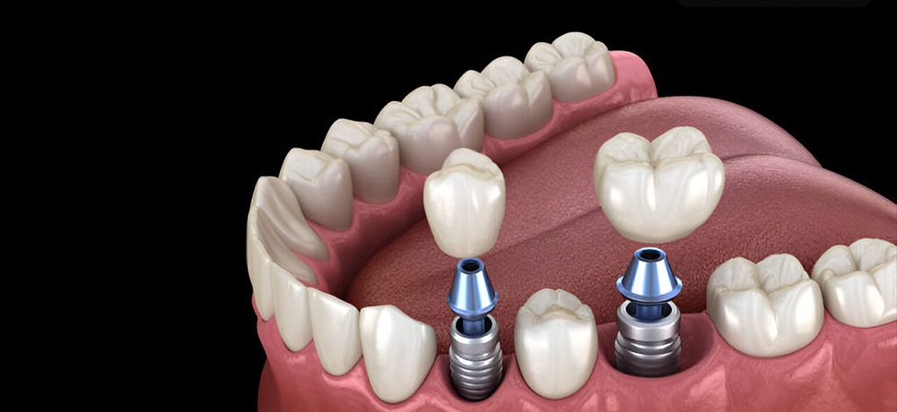 فرق ایمپلنت و کامپوزیت