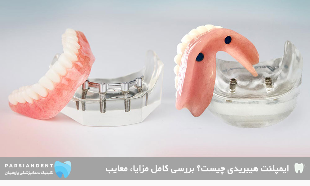 ایمپلنت هیبریدی چیست