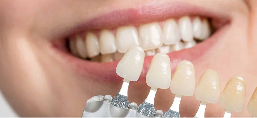 فرق ایمپلنت با کامپوزیت