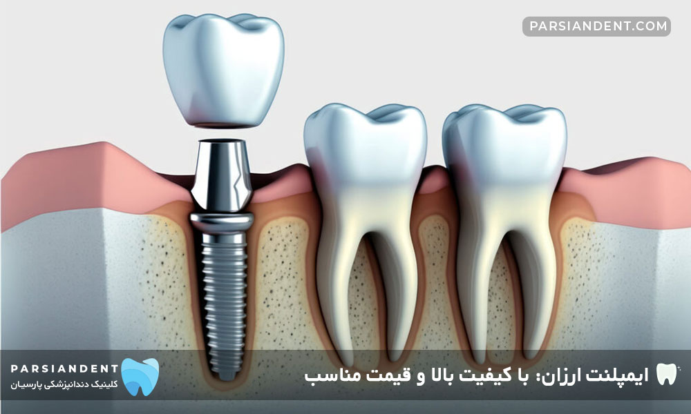 قیمت‌های ایمپلنت ارزان